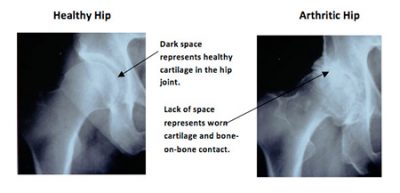 Hip Resurfacing Bone And Joint Specialists Michigan Hip Expert