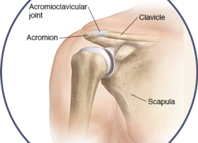 What is a Separated Shoulder?